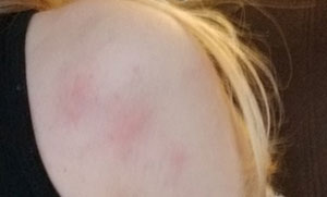 hives vs bed bug bites