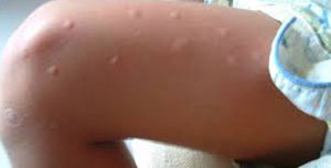 mosquito bites vs bed bug bites